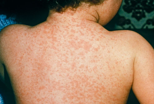 Slideshow: 11 Common Causes of Skin Rashes and Itchy ...