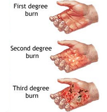 2nd degree burns blisters